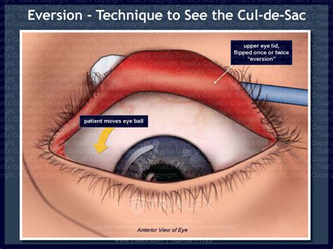 cul fill|what is cul de sac technique.